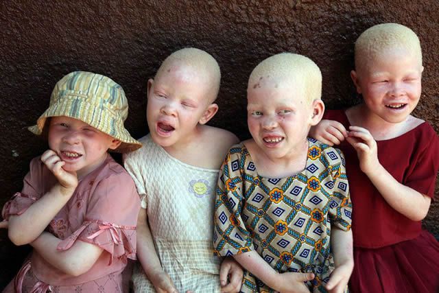 albinos tanzania 10
