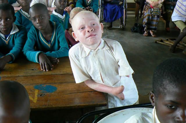 albinos tanzania 12
