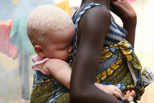 Resultado de imagen para niÃ±a de descendencia negra con albinismo