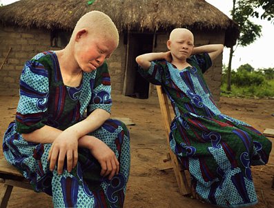 albinos tanzania 4