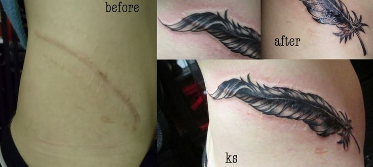 tatuajes en cicatriz 14