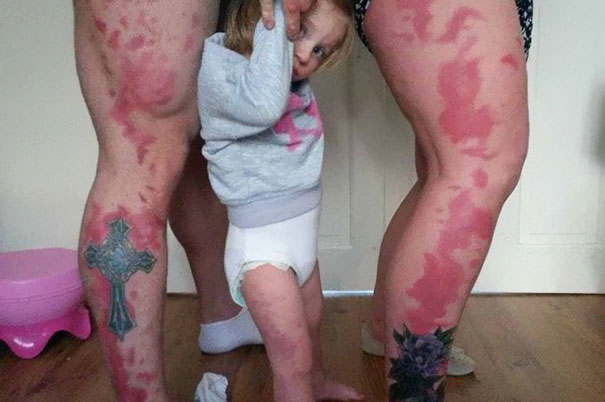 padres se tatuan las manchas de la piel de su hija 2
