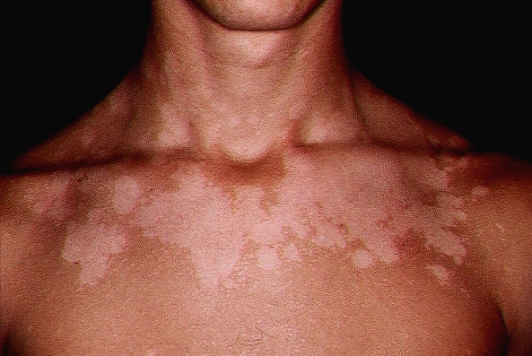 manchas en la piel