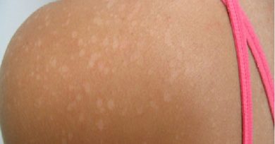 manchas blancas en la piel