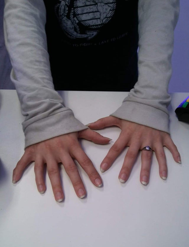 20 fascinantes fotografías manos con polidactilia