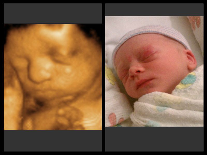 ecografía bebé antes y después hd