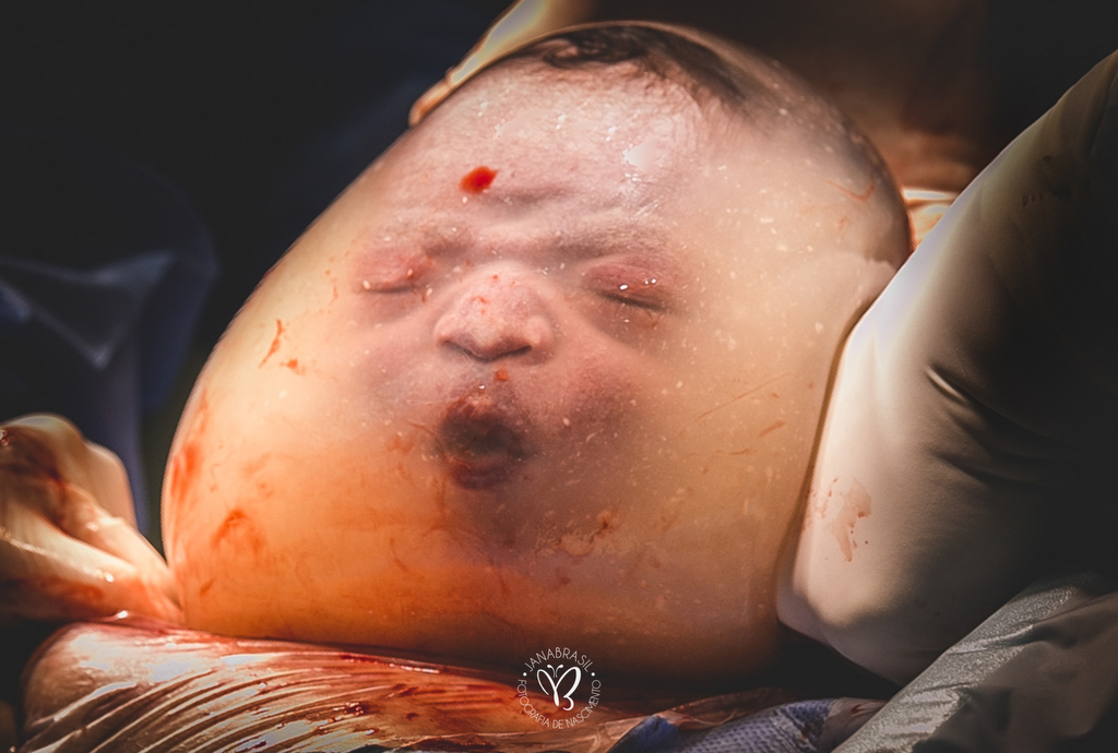 bebé dentro del saco amniótico fotografía de partos
