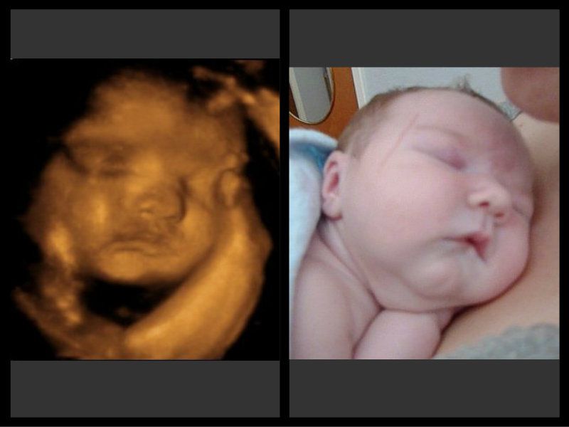 ecografía 4d antes y después de bebé